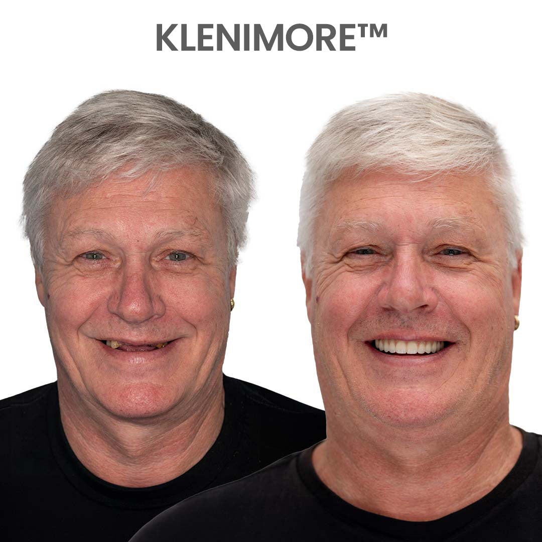 ⏰ Custom-Fit Dentures ENDS TODAY 70% OFF | Smile with Confidence|Buy 2, Get 1 Free
