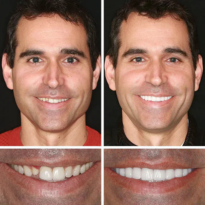 ⏰Ends Today: 70% OFF! 🌎Custom-Fit  Dentures— Designed for Comfort and a Natural-Looking Smile