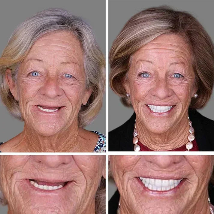 ⏰Ends Today: 70% OFF! 🌎Custom-Fit  Dentures— Designed for Comfort and a Natural-Looking Smile