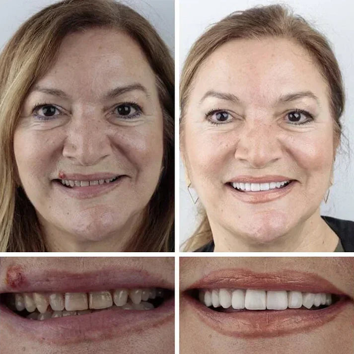⏰Ends Today: 70% OFF! 🌎Custom-Fit  Dentures— Designed for Comfort and a Natural-Looking Smile
