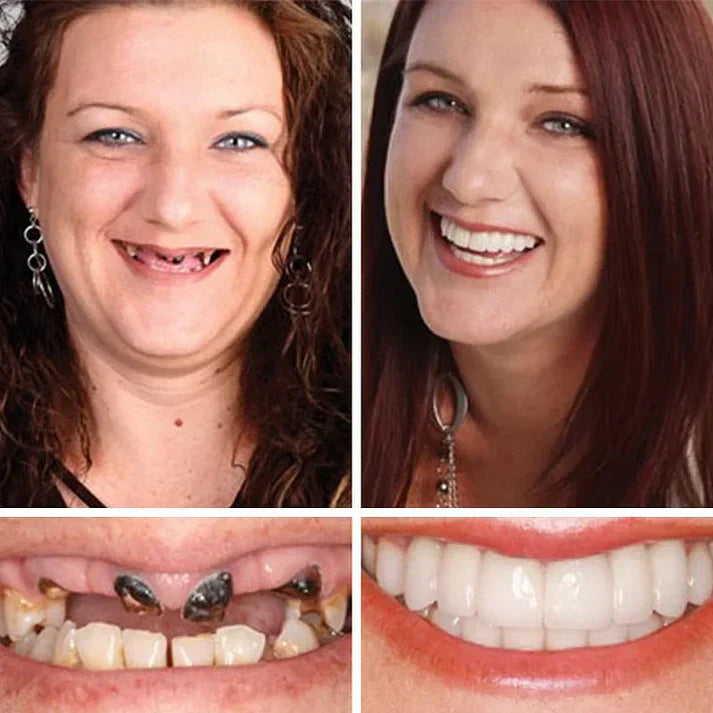 ⏰Ends Today: 70% OFF! 🌎Custom-Fit  Dentures— Designed for Comfort and a Natural-Looking Smile