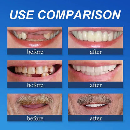 ⏰Ends Today: 70% OFF! 🌎Custom-Fit  Dentures— Designed for Comfort and a Natural-Looking Smile